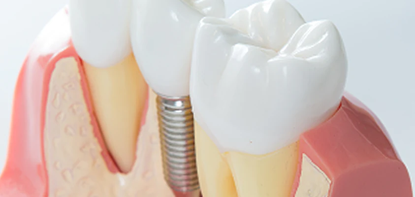 Implantes Dentários